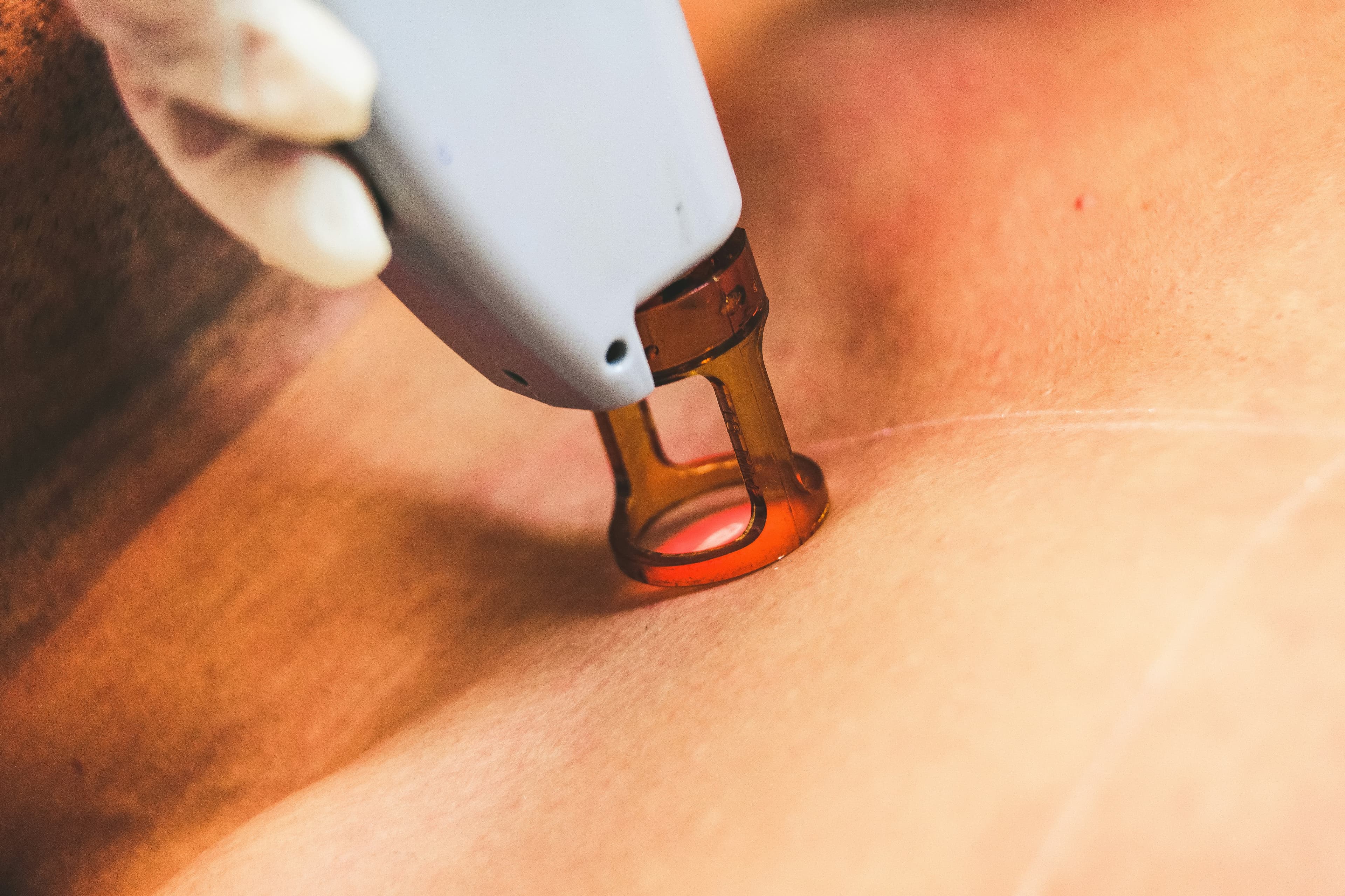 A laser hair removal handpiece held in hand
